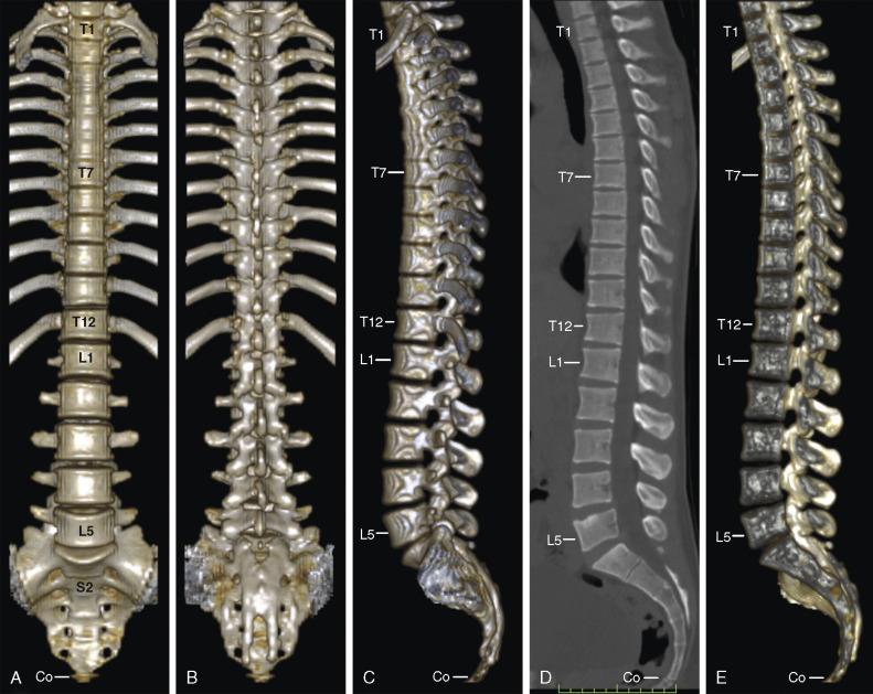 FIGURE 3-2, 3D CT surface reformatted images of the anterior ( A ), posterior ( B ), and lateral ( C ) surfaces of the thoracolumbosacral spine in a 27-year-old man. D , Midsagittal reformatted image of the spine. E , 3D sagittal cut-away reformatted image to display the interior and the opposite side of the spine from the midline.