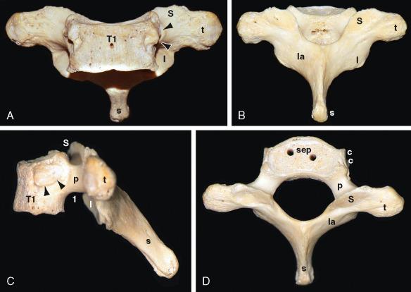 FIGURE 3-3, Isolated dried T1 vertebra. Anterior ( A ), posterior ( B ), lateral ( C ), and superior ( D ) surfaces. Four views demonstrate the vertebral body (T1), pedicle (p), superior (S) and inferior (I) articular processes and facets, the transverse process (t), lamina (la), spinous process (s), and costocapitular facet ( arrowheads ). In lateral view ( C ) the gentle concavity of the upper border of the pedicle (p) is the superior vertebral notch. The deep concavity of the lower border of the pedicle is the inferior vertebral notch. The segmental T1 nerve roots (1) exit through the T1-T2 neural foramen just inferior to the T1 pedicle. The superior end plate (sep) of the vertebral body displays a rim of dense cortical bone and a central region of cancellous bone. The head of the T1 rib articulates with the side of the T1 vertebral body at the costocapitular (costovertebral) facet ( arrowheads ; cc). In this and other images, the paired “drill holes” indicate that the segmental vertebrae had been strung together to form a spinal column.