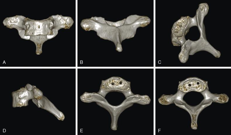 FIGURE 3-4, 3D surface reformatted images of the dried T1 vertebra illustrated in Figure 3-3 . Anterior ( A ), posterior ( B ), posterosuperior ( C ), lateral ( D ), superior ( E ), and inferior ( F ) surfaces. See Figure 3-3 to identify structures.