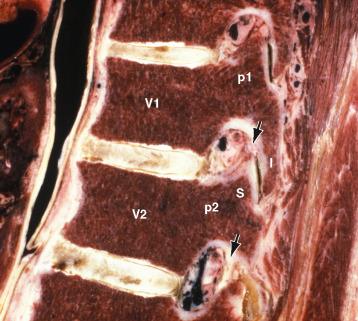 FIGURE 3-5, Parasagittal cryomicrotome section through the pedicles, neural foramina, and zygapophyseal (facet) joints of adjacent thoracic vertebrae. The outer surfaces of the vertebral bodies, pedicles, and articular surfaces of the facets show dense cortical bone. The interior surfaces show cancellous bone containing homogeneous red marrow. The facet joint (S/I) has a steep coronal orientation. The ovoid neural foramina are bounded superiorly by the deep inferior vertebral notch of the upper pedicle (p1), inferiorly by the shallow superior vertebral notch of the lower pedicle (p2), anteriorly by the posterior surfaces of the upper vertebral body (V1) and the V1-V2 disc, and posteriorly by the ligamentum flavum ( arrows ) and superior articular facet (S) of the lower vertebra (V2). The neural foramina contain epidural fat, traversing veins, segmental nerve roots, and the segmental dorsal root ganglia.