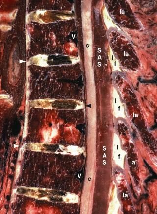 FIGURE 3-8, Paramedian cryomicrotome section through the midthoracic spine. The cancellous bone displays both red and yellow marrow. Superiorly and inferiorly, the vertebral bodies are joined by the intervertebral symphyses composed, in part, of the paired upper and lower vertebral margins, the hyaline cartilage end plates, and the intervening discs. Aging pigment discolors the discs in this specimen. Anteriorly and posteriorly the vertebral bodies are joined by the tough anterior longitudinal ligament ( white arrowheads ) and posterior longitudinal ligament ( black arrowhead ). Posteriorly, the laminae are joined by the segmental ligamenta flava (lf) that attach to the anterior cortical surface of the lower half of each lamina (la) and insert into the cortical surface of the upper margin and adjacent posterior face of the next-lower lamina. Because of the thoracic kyphosis, the spinal cord (c) lies in the anterior portion of the spinal canal and the subarachnoid space (SAS) appears widened behind it. The basivertebral veins (v) at the mid heights of the vertebrae drain posteriorly into the anterior internal vertebral venous plexus situated ventral to the posterior longitudinal ligament.