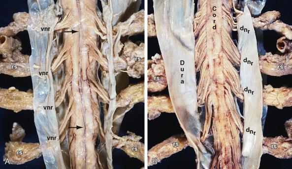 FIGURE 5-1, Gross anatomy of the cervicothoracic spinal cord seen through the opened dura and arachnoid at postmortem examination. A , Anterior surface. The ventral (motor) roots (vnr) arise from the spinal cord segmentally. They form relatively narrow bundles of rootlets that cross the subarachnoid space anterior to the denticulate ligament toward the segmental root sleeves (rs). B , Posterior surface. The dorsal (sensory) rootlets (dnr) arise laterally from the segmental dorsal root ganglia and cross the subarachnoid space dorsal to the denticulate ligament. The dorsal rootlets form relatively broad “brushes” of fibers that enter the spinal cord at the dorsal root entry zone over the full length of each segment. The anterior spinal artery ( arrow , A ) appears as a single vessel that courses longitudinally in the midline. The paired dorsal spinal arteries (unlabeled) appear as more tenuous, incomplete vessels that course longitudinally just medial to the dorsal root entry zone.