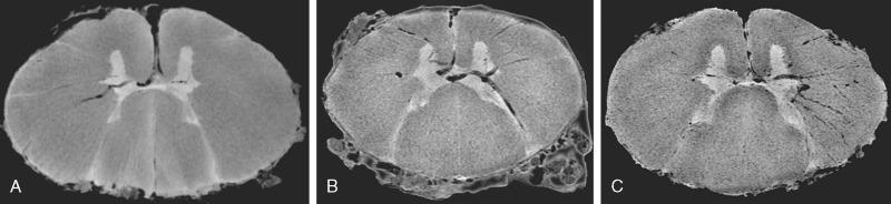 FIGURE 5-11, Intrinsic vasculature of the cervical spinal cord seen on axial postmortem 9.4-T MR images. A to C , Composite minimum intensity projections of multiple contiguous axial sections emphasize the ventral supply via the ventral median sulcus, the presence of vessels oriented along the dorsal horns, and the radial array of the vasculature within the white matter.