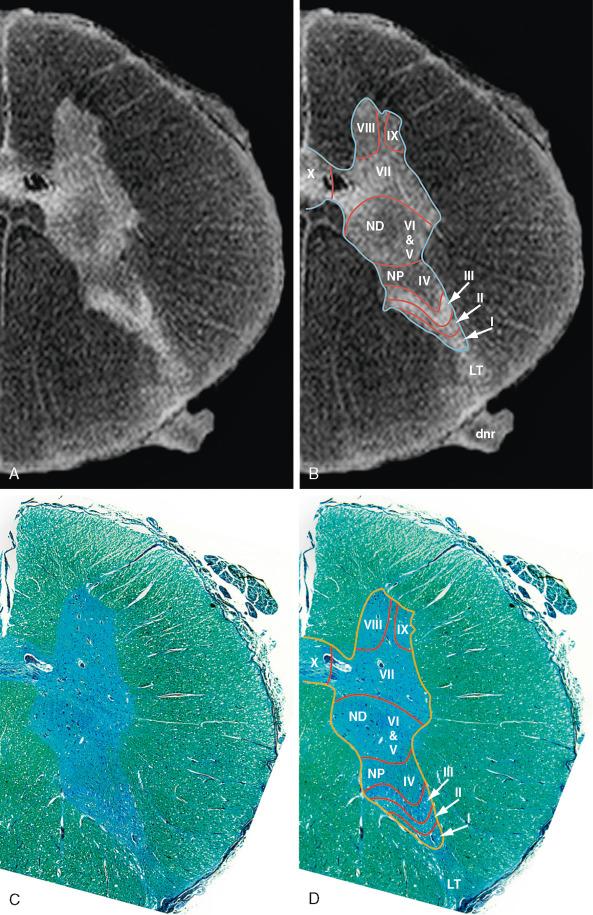 FIGURE 5-13, Rexed laminae. A , Axial postmortem 9.4-T MR image of the thoracic hemicord. B , Luxol Fast Blue stain of the same specimen. C and D , Rexed laminae delineated on A and B . RLs I to X extend across the full thickness of the gray matter, as shown in Figure 5-12 . RL I corresponds to the nucleus marginalis. RLs II and III correspond to the substantia gelatinosa. RL IV contains the nucleus proprius (NP). RLs V and VI are not distinguishable in humans. The full extent of RL VII is better depicted in Figure 5-12 . At spinal levels C8 to L2, the nucleus dorsalis (ND) (of Clarke, Clarke's column) lies at the base of RL VII medially. In the distal cord, RL VIII lies medially and RL IX laterally within the ventral horn, interspersed within the broad RL VII. RL X corresponds to the gray matter about the central canal. The dorsolateral fasciculus (tract) of Lissauer (LT) lies at the entry of the dorsal nerve roots (see also Figs. 5-5B and 5-6 ).