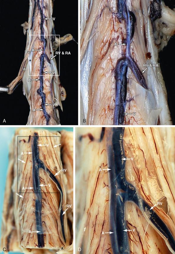 FIGURE 5-2, Anterior surfaces of the formalin-fixed thoracolumbar spinal cord. Short segments of two specimens ( A , C ) with magnified views ( B , D ) of the anterior vessels. A , The ventral (motor) rootlets (v) pass anterior to the denticulate ligament ( asterisk , A ) to enter the root sleeves with the dorsal nerve roots (d). Radiculomedullary arteries (RA) and veins (RV) course along the nerve roots of either side to supply the thinner, more superficial anterior spinal axis (A) and drain the larger, deeper midline anterior spinal vein (V). Note the fine radicular vessels ( arrows , C ) that supply each rootlet.