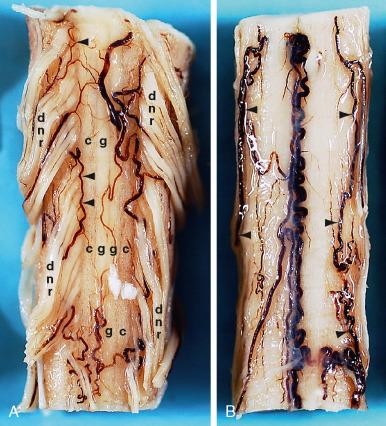 FIGURE 5-3, Posterior surfaces of the formalin-fixed cervicothoracic spinal cord. Short segments of two specimens. The dorsal nerve roots (dnr) fan out into multiple rootlets that enter the cord at the dorsolateral sulci. The paired gracile (g) and cuneate (c) fasciculi are faintly outlined by the shallow midline dorsal median sulcus, the paired dorsal intermediate sulci between them, and the dorsal root entry zones at the dorsolateral sulci lateral to them. Multiple radiculomedullary arteries feed the paired dorsal spinal arteries ( arrowheads ), which form incomplete longitudinal channels just medial to the dorsal root entry zones. These channels feed into a pial arterial plexus (designated the “vasocorona”) that supplies the dorsal portion of the spinal cord. The posterior median vein may form a dorsal midline “hairpin turn” as it drains peripherally via radiculomedullary veins. These may mimic the hairpin turn of the radiculomedullary arteries to the anterior spinal axis. The dorsal midline veins are often serpiginous.