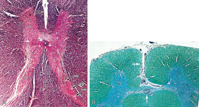 FIGURE 5-4, Axial histologic specimens. A , Central spinal cord (H & E stain). B , Ventral spinal cord (Luxol Fast Blue stain for myelin). The central canal of the spinal cord ( vertical midline arrows ) is lined by ependyma. The surrounding cylinder of gray matter appears H-shaped in axial sections with paired ventral horns (v) and dorsal horns (d). The crossbar of the H is formed by the gray matter that surrounds the central canal. Differing concentrations of cells within the gray matter correspond to named histologic laminae and named spinal nuclei, such as the cellular nucleus proprius (np), more myxoid substantia gelatinosa (sg), and apical cap of the nucleus marginalis (nm). The ventral midline shows the deep open ventral median sulcus ( crossed horizontal arrows ) containing the sulcomarginal vessels. The dorsal midline shows the glial dorsal median septum ( black arrowheads ). The vessels within the white matter show a radial distribution.