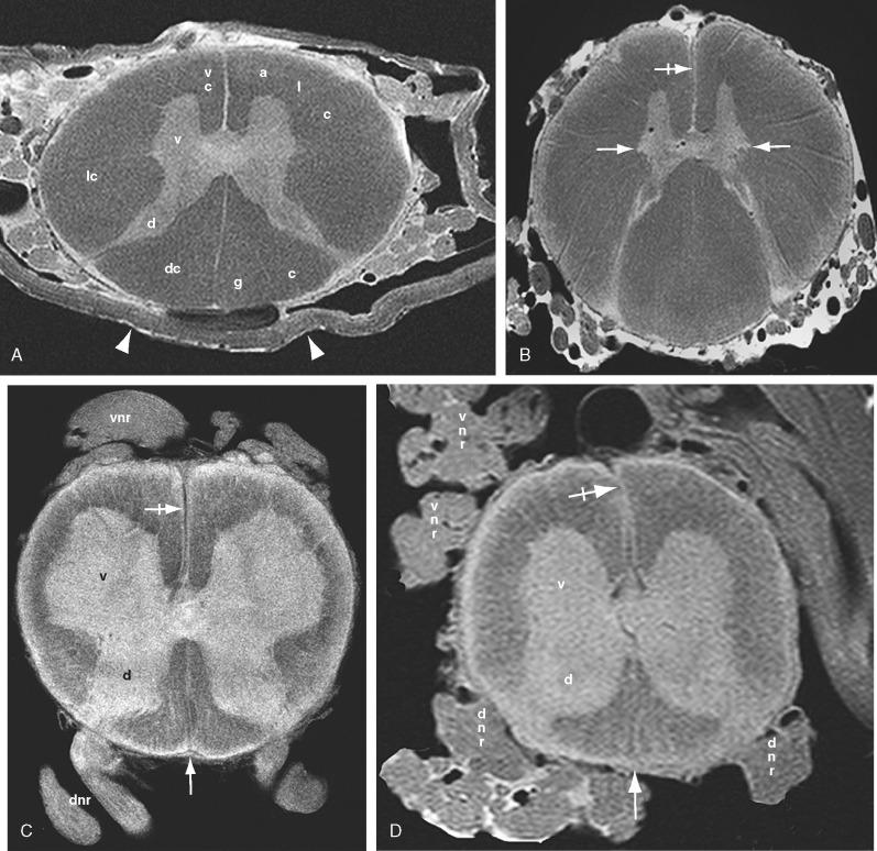 FIGURE 5-5, Normal spinal cord at the cervical ( A ), thoracic ( B ), lumbar ( C ), and sacral ( D ) cord levels shown on axial postmortem 9.4-T MR images. The sagittal dimension of the cord is relatively constant from cervical to lumbar levels and then tapers distally. The transverse dimension shows cervical and lumbar expansions for the shoulder and pelvic girdles. The volume of white matter is greatest in the cervical cord and diminishes progressively caudad. In cross section, the central gray matter forms an H or “butterfly” shape with paired ventral (v) and dorsal horns (d) united by a transverse band of gray matter that encloses the central canal. The thoracic cord displays additional paired lateral horns ( horizontal arrows , B ). The cord surface is demarcated by a deep ventral median sulcus ( crossed horizontal arrows ), a shallow dorsal median groove with subjacent deep dorsal median septum ( vertical white arrow , C ), paired ventrolateral sulci at which the ventral nerve roots (vnr) emerge from the ventral horns, and paired dorsolateral sulci at which the dorsal roots (dnr) enter the dorsal horns. The dorsolateral fasciculus of Lissauer (Lissauer's tract) manifests as high signal intensity at the dorsal root entry zone ( B ). Superficial to the gray matter, the white matter of the spinal cord is arrayed in longitudinal tracts designated columns (funiculi). The paired ventral columns (vc) extend between the ventral median sulcus and the lateral margins of the emerging ventral roots, including the ventral roots. The paired dorsal columns (dc) lie between the dorsal median septum and the entry of the dorsal roots at the dorsolateral sulci. The lateral columns (lc) lie between the ventral and dorsal columns. The term anterolateral column (alc) is useful to designate the adjoining portions of the anterior and lateral columns that surround the emerging ventral nerve roots. In the upper thoracic and cervical cords (from T6 upward), a dorsal intermediate septum subdivides the dorsal columns into paired fasciculi graciles (g) medially and paired fasciculi cuneati (c) laterally. Note the low signal intensity of the fibrous dura ( arrowheads , A ) surrounding the nerve roots and cord and the intermediate signal intensity of nerve roots versus the low signal intensity of vessels in the subarachnoid space ( B ).