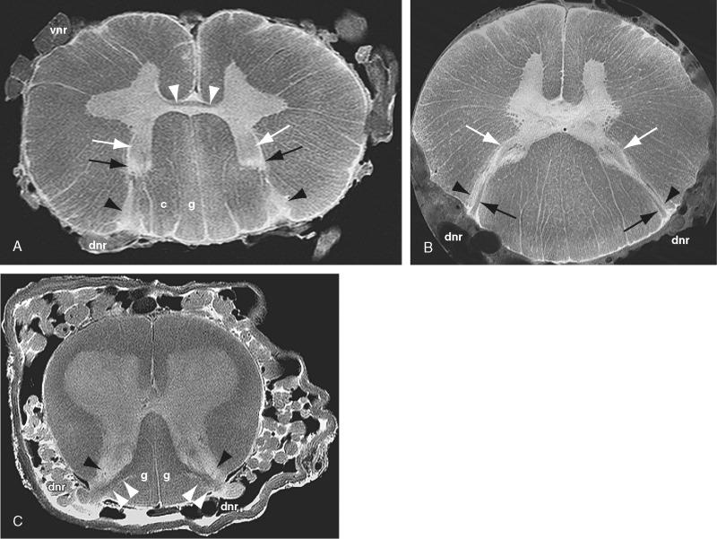 FIGURE 5-6, Axial postmortem 9.4-T MR images of the spinal cord. A and B , Cervical levels in two specimens. Myelinated fibers crossing the midline form the ventral white commissure ( white arrowheads , A ) just dorsal to the ventral median sulcus and just ventral to the ventral gray commissure. As they approach the dorsal root entry zone (DREZ) dorsal nerve rootlets (dnr) sort out into more heavily myelinated fibers ( black arrows , B ) that enter the medial portion of the DREZ and thinly myelinated or unmyelinated fibers that enter the lateral portion of the DREZ. The dorsal tract of Lissauer ( black arrowheads ) surrounds the entering dorsal nerve roots and appears bright owing to the limited myelination of its fibers. C , Lumbar level. The dorsal root fibers with thick myelination ( white arrowheads ) enter the medial aspect of the DREZ. The dorsal tract of Lissauer ( black arrowheads ) appears bright. The dorsal columns contain only the fasciculus gracilis (g) at the lumbar level but fasciculi graciles (g) and cuneati (c) at the cervical level. Also labeled: nucleus proprius ( thick white arrows , A , B ), substantia gelatinosa ( black arrows , A ), ventral nerve roots (vnr), and dorsal nerve roots (dnr).