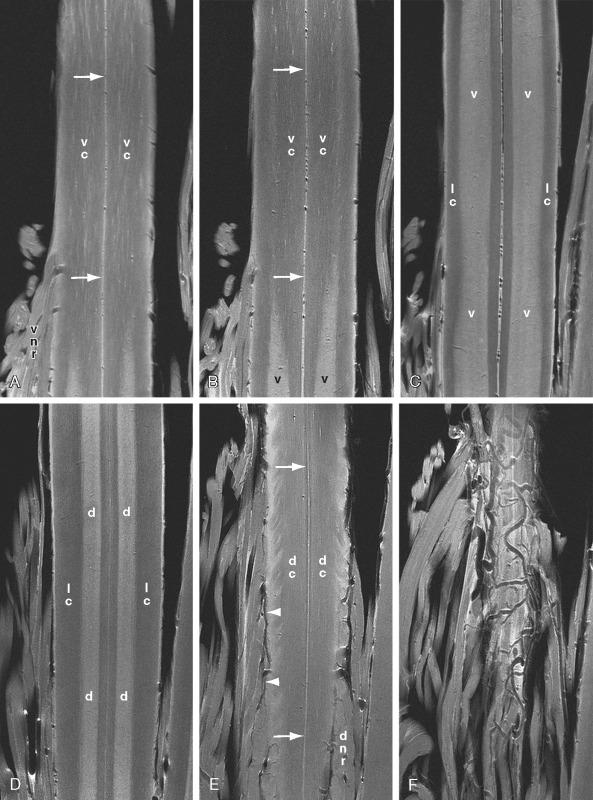 FIGURE 5-7, Normal thoracolumbar spinal cord. Coronal postmortem 9.4-T MR images displayed from ventral ( A ) to dorsal ( F ). A and B , Coronal sections through the ventral columns (vc) display the ventral median sulcus ( white arrows ) in the midline and motor roots (vnr) exiting at the ventrolateral sulcus. The sulcomarginal vessels enter the ventral median sulcus singly, not in pairs, and pass dorsally toward the depth of the sulcus. C , Further dorsally, coronal MR sections display the deep portion of the ventral median sulcus and the vessels within it, the deep portions of the ventral white columns just to each side of the sulcus, the broad ventral horns (v) that flank them, and anterior portions of the lateral columns superficially. D , Within the dorsal half of the cord, coronal MR sections display the dorsal median septum, the deep portions of the dorsal columns, the thin dorsal horns (d), and the dorsal portion of the lateral columns. E , Coronal section through the dorsal columns shows the dorsal median septum ( white arrows ), the emerging dorsal nerve roots (dnr), and the dorsal spinal arteries that form an incomplete longitudinal plexus just medial to the dorsal nerve roots. F , The dorsal surface of the cord shows the dorsal venous plexus that drains into radiculomedullary veins.