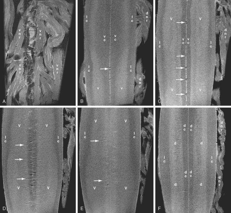 FIGURE 5-8, Normal thoracolumbar spinal cord. Coronal postmortem 9.4-T MR images displayed from ventral ( A ) to dorsal ( K ). A , Vasculature of the ventral surface of the cord and the ventral nerve roots (vnr). B and C , The sulcomarginal vessels ( horizontal white arrows ) course dorsally through the ventromedian sulcus flanked, from medial to lateral, by the deep portions of the ventral white columns (vc), the gray matter of the ventral horns (v), and the anterior portions of the lateral columns (lc). Behind the ventralmost end of the ventral horn, the nerve roots seen about the cord are the dorsal nerve roots (dnr) passing ventrally toward their root sleeves. D and E , In these sections the deep extent of white matter of the ventral columns gives way to the gray matter that surrounds the central canal. The dorsal ends of the sulcomarginal arteries ( arrows ) ramify dorsolaterally into the ventral horns (v) and into the central gray matter ( E ). F and G , Dorsal to the central canal, the midline is formed by the glial dorsal median septum ( horizontal white arrows ). The dorsal horns (d) diverge dorsolaterally from near to the midline (in E ) into the lateral portions of the dorsal cord (in F ) to give rise to the dorsal nerve roots (dnr). They are flanked by the deep portions of the dorsal columns (dc) medially and the dorsal portions of the lateral columns (lc) laterally. H and I , The “paired” dorsolateral arteries form incomplete longitudinal channels medial to (dorsal arteries) or lateral to (dorsolateral arteries) the dorsal root entry zones. The dorsal median septum ( white arrows ) separates the paired fasciculi graciles of the dorsal columns. J and K , The dorsal surface of the cord also displays a prominent dorsal vein ( arrowheads ) that exhibits a hairpin turn similar to that formed by the anterior spinal artery on the opposite side of the cord.