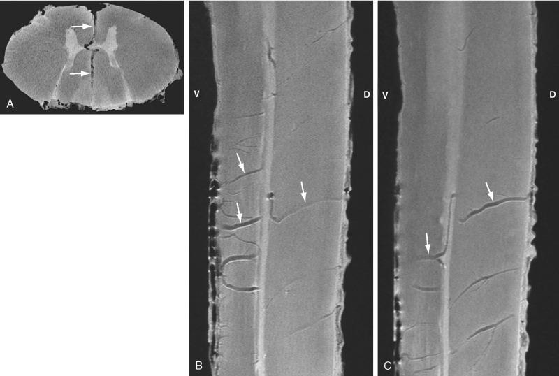 FIGURE 5-10, Transmedullary anteroposterior venous anastomosis. Axial ( A ) and sagittal ( B , C ) postmortem 9.4-T MR images. A , Minimum intensity projection of multiple contiguous axial sections. As in this example ( arrows ), large anastomotic midline veins cross the full thickness of the spinal cord coursing through the ventral median sulcus, around the central canal, and through the dorsal median septum to interconnect the ventral and dorsal median longitudinal veins. B and C , Thin paramedian sagittal sections. The large transmedullary anastomoses may ascend or descend from ventral to dorsal but typically show a characteristic vertical “jig” as they circumnavigate the central canal. D, dorsal; V, ventral.