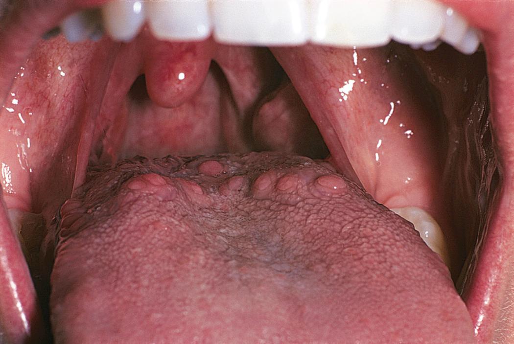 Fig. 12.3, Circumvallate Papillae.