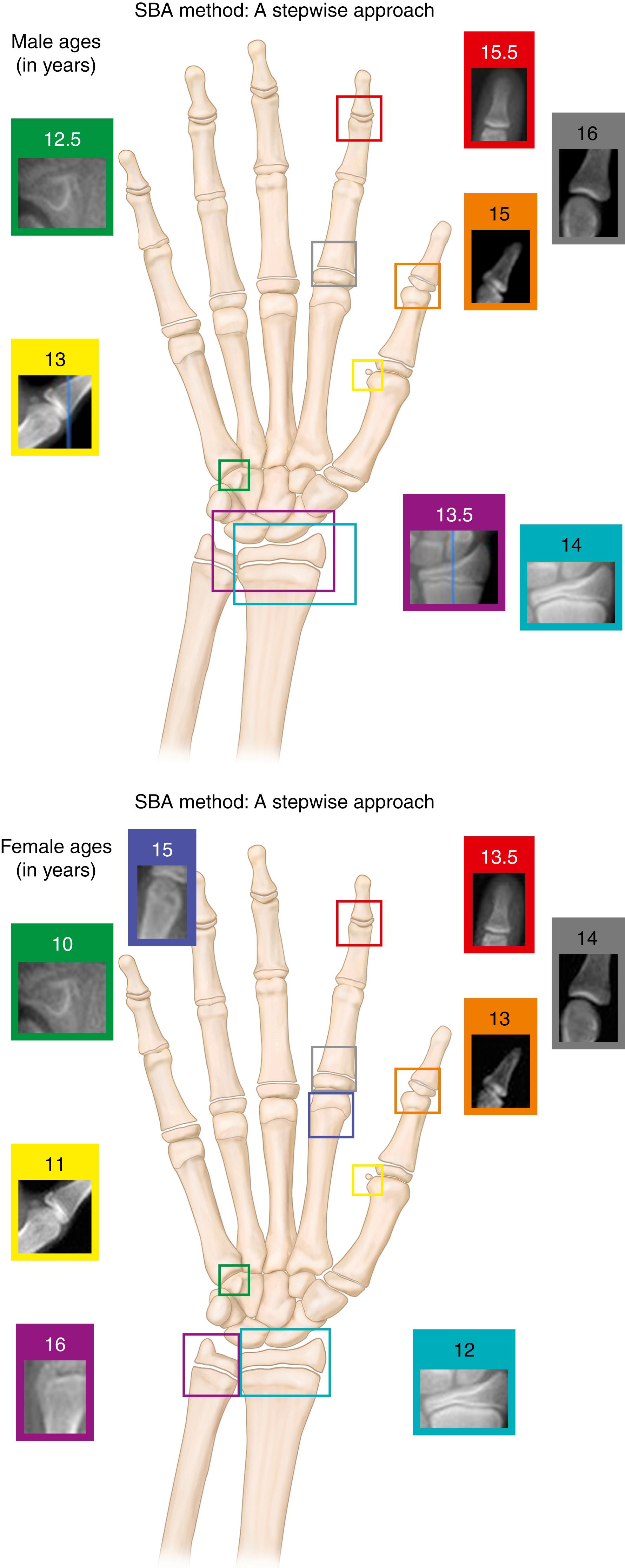 Fig. 36.1, Short hand bone age method for assessment of skeletal maturity, based on predictable anatomical development for boys and girls.