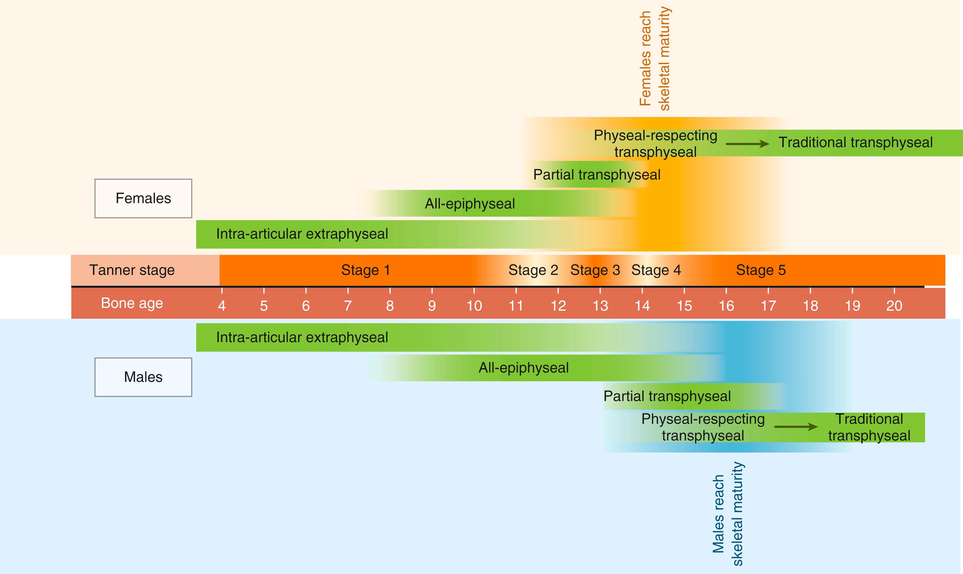 Fig. 36.3, Graphical representation of anterior cruciate ligament (ACL) reconstruction options for patients, based on level of maturity.