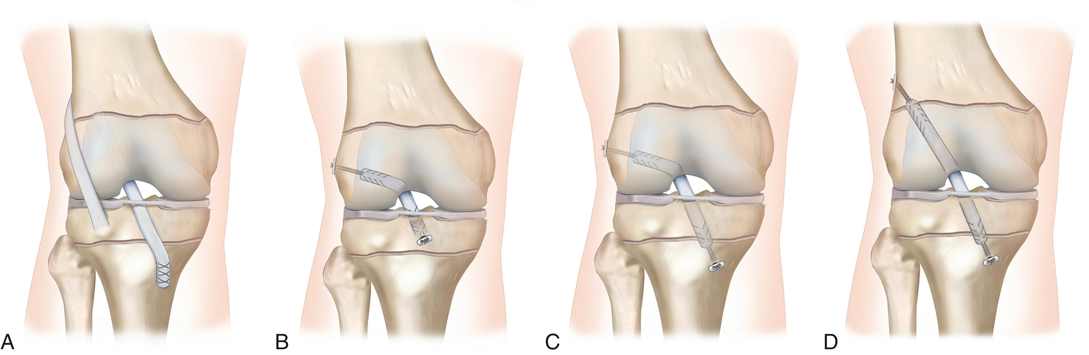 Fig. 36.4, Anterior cruciate ligament (ACL) reconstruction techniques in paediatric patients in right knees.