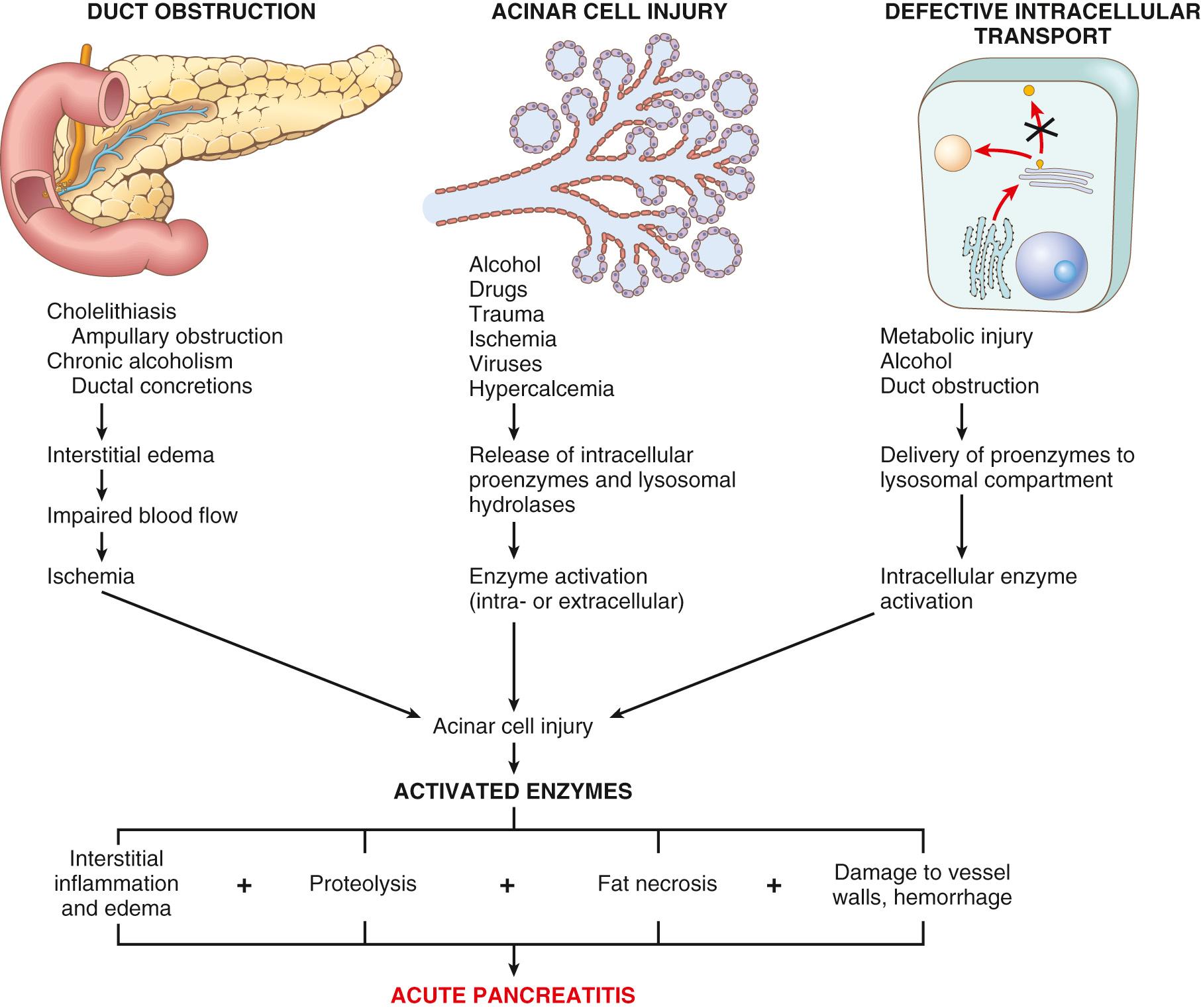 Figure 19.2, Three proposed pathways in the pathogenesis of acute pancreatitis.