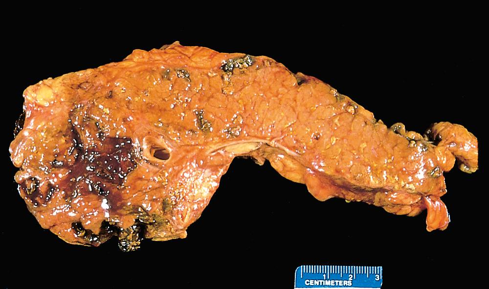 Figure 19.4, The pancreas has been sectioned longitudinally to reveal dark areas of hemorrhage in the head of the pancreas and a focal area of pale fat necrosis in the peripancreatic fat (upper left).