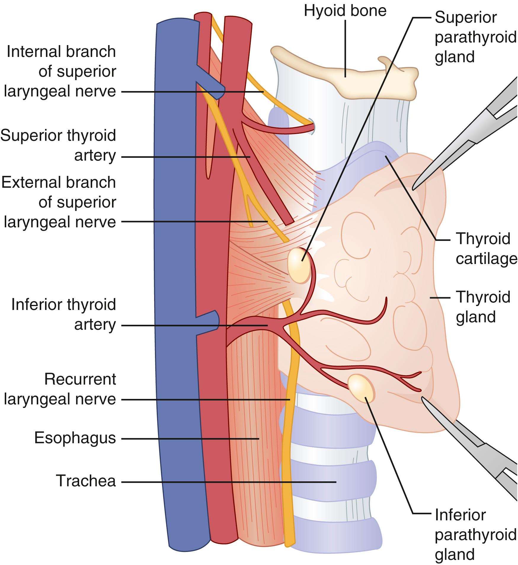 Fig. 38.4, The superior and inferior parathyroid glands and their normal anatomic relationships are depicted with the right lobe of the thyroid gland retracted anteriorly and medially.