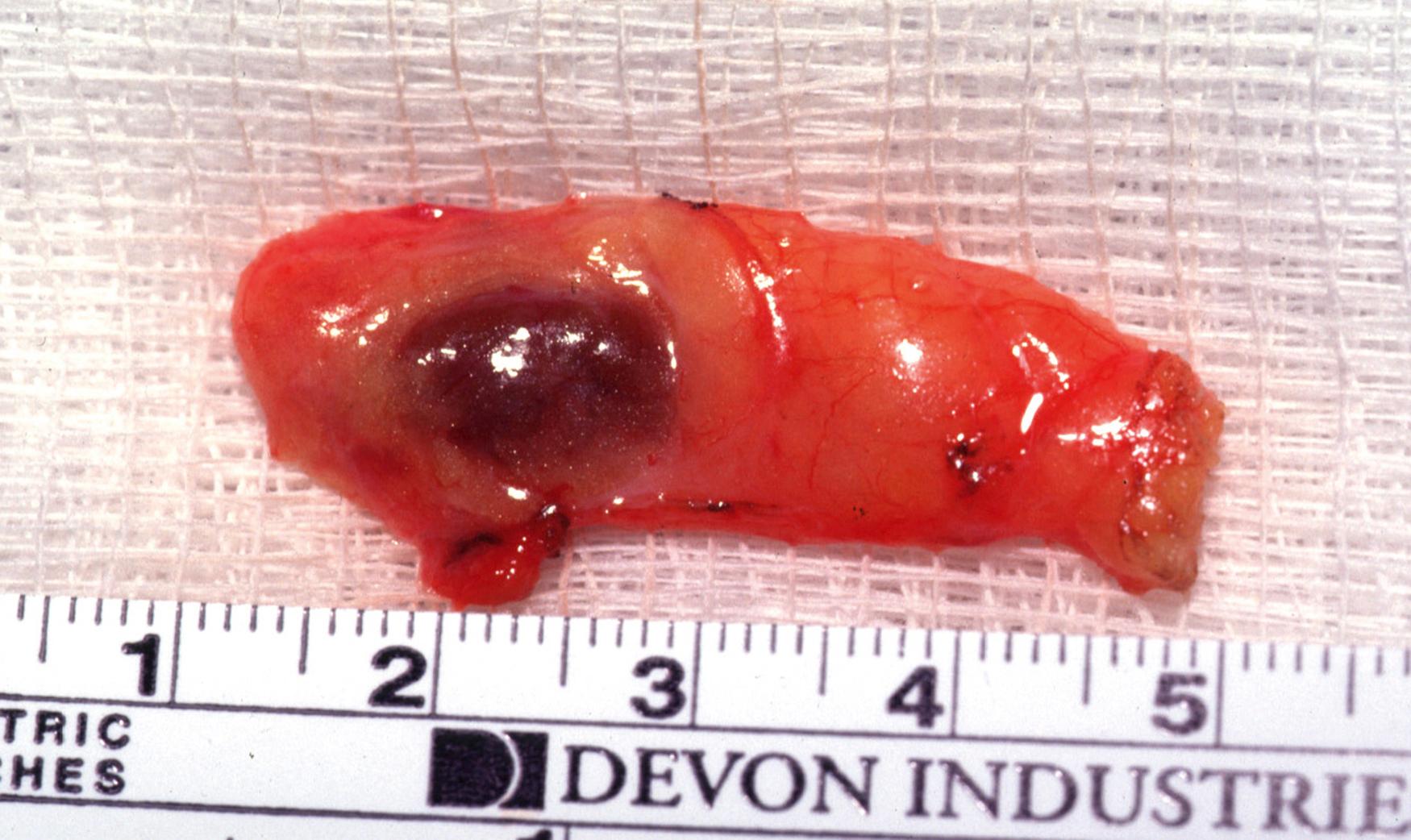 Fig. 38.5, Ectopic intrathymic parathyroid adenoma.