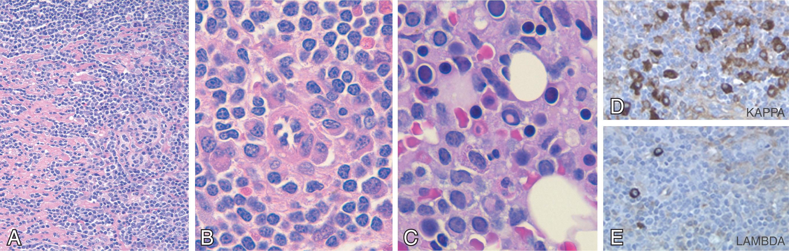 Figure 78.2, LYMPHOPLASMACYTIC LYMPHOMA (LPL)