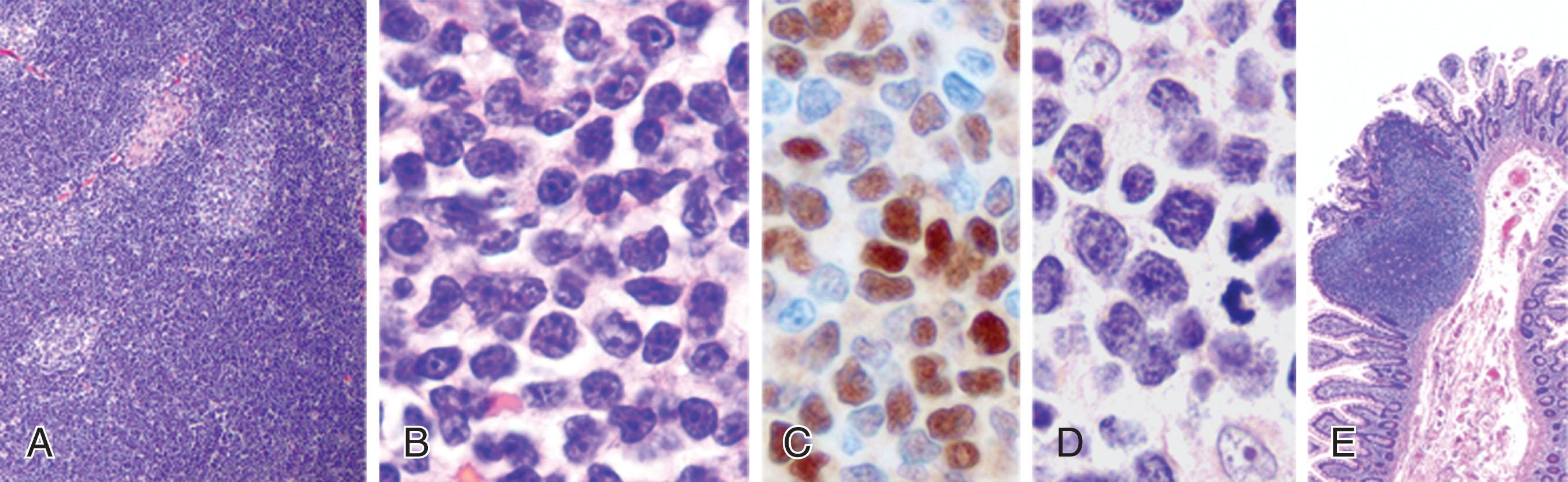 Figure 78.3, MANTLE CELL LYMPHOMA