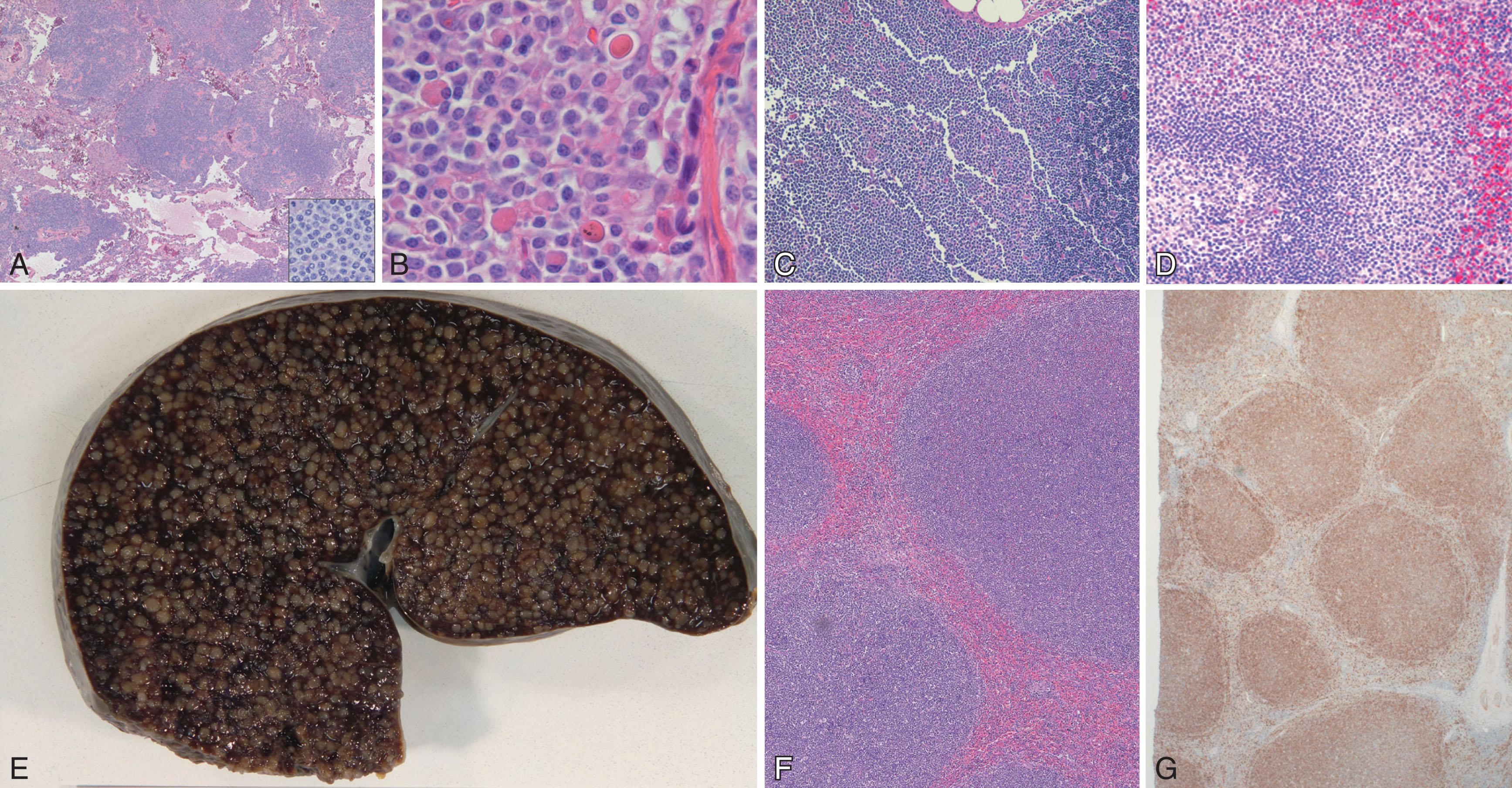 Figure 78.5, MARGINAL ZONE LYMPHOMA