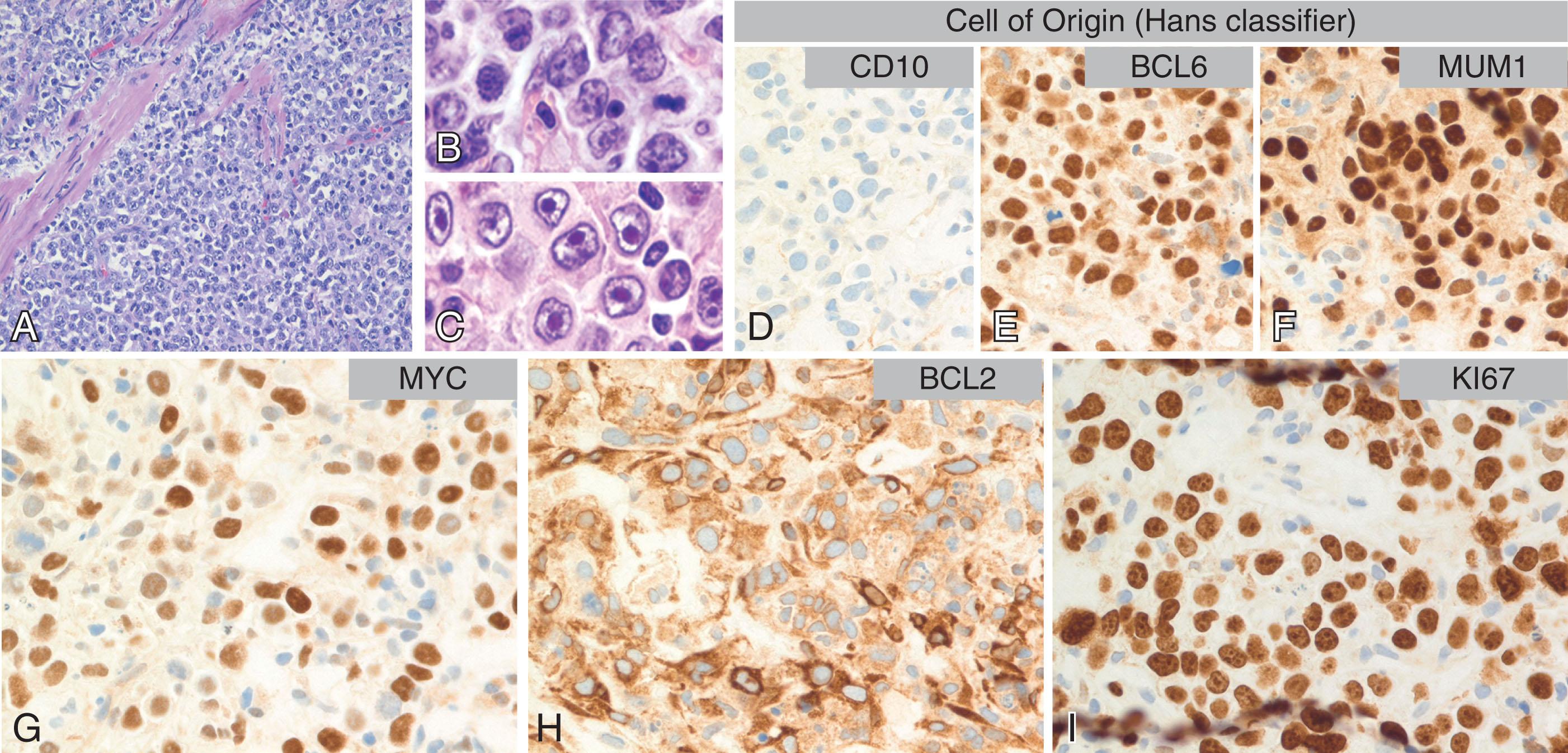 Figure 78.6, DIFFUSE LARGE B-CELL LYMPHOMA