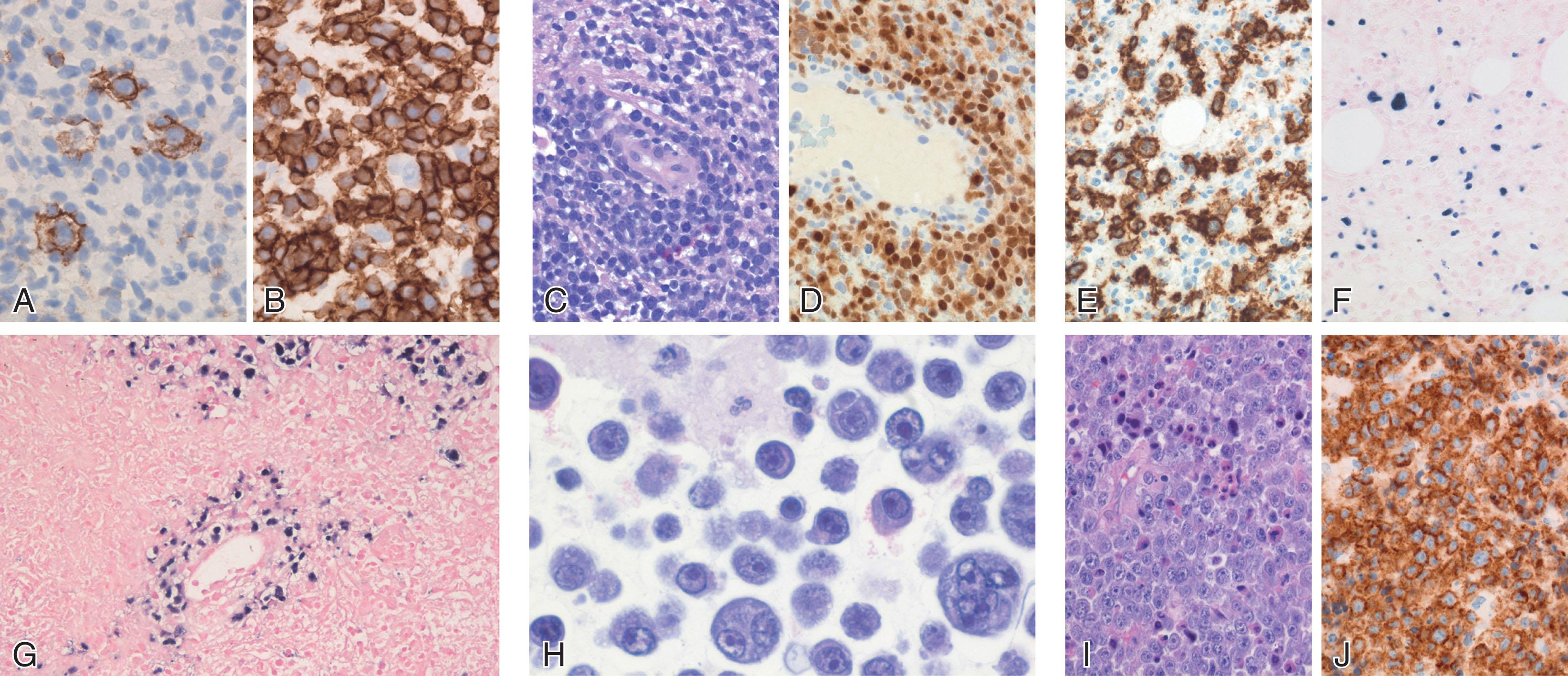 Figure 78.7, DIFFUSE LARGE B-CELL LYMPHOMA, VARIANTS, AND SUBTYPES