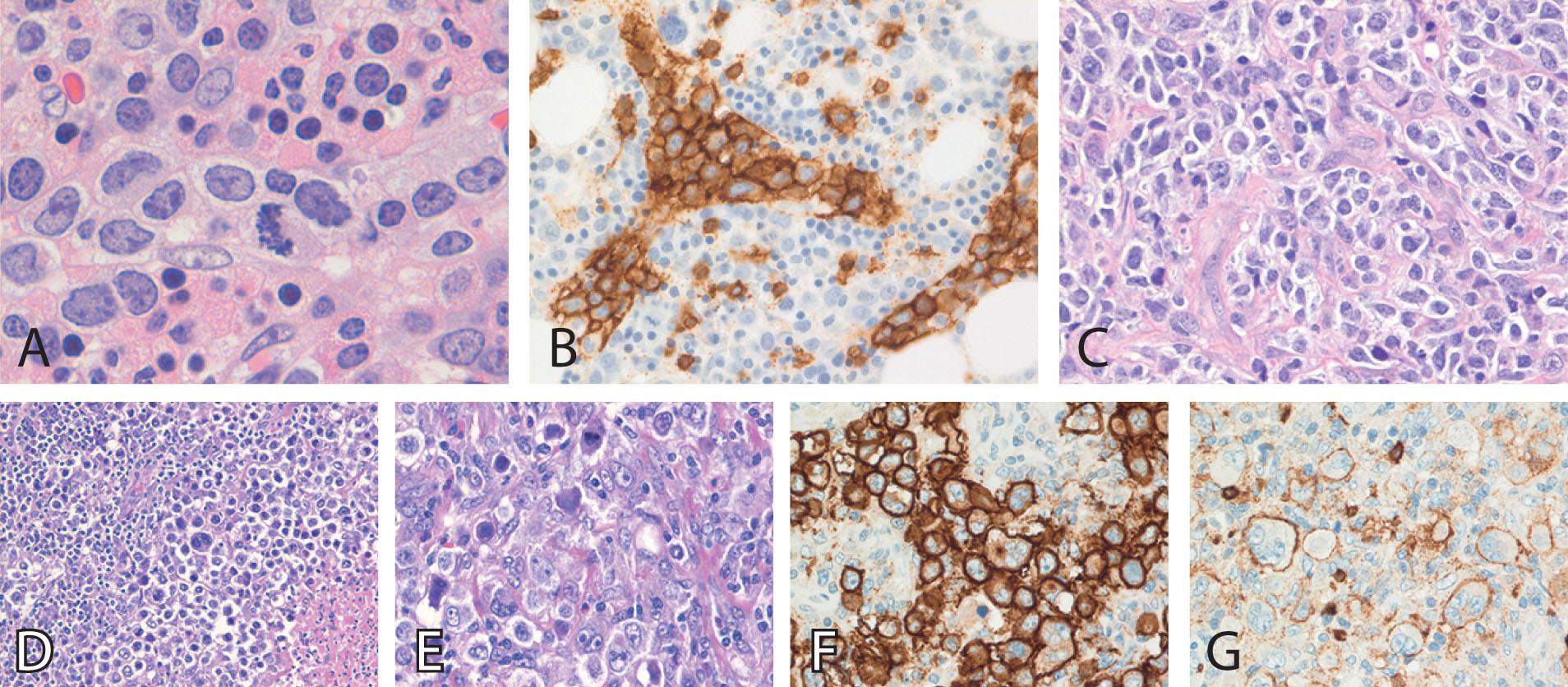 Figure 78.8, DIFFUSE LARGE B-CELL LYMPHOMA VARIANTS (INTRAVASCULAR, MEDIASTINAL, GRAY ZONE)