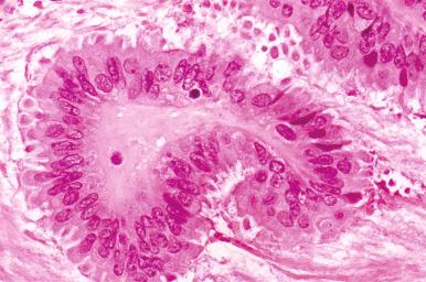 Fig. 25.11, Serous borderline tumor (SBT). Bland columnar cells with surface blebs surround the papilla.