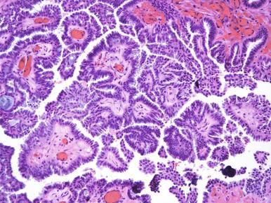 Fig. 25.13, Exuberant growth in a serous borderline tumor (SBT).