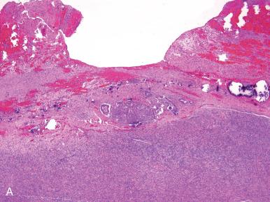 Fig. 25.14, A, Surface involvement by a borderline serous tumor. B, Microinvasion in a serous borderline tumor (SBT). Several round cells, some with a peripheral space, percolate through the stroma of a papilla. As in this example, they are often inconspicuous and easily overlooked. They may be highlighted with a keratin stain. C, Microinvasion in an SBT. Irregular epithelial islands in a stroma that appears to be reactive.