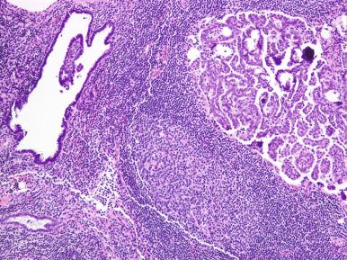 Fig. 25.15, Lymph node metastases in a borderline tumor (right). A focus of endosalpingiosis is on the left for comparison.