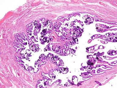 Fig. 25.16, Microcalcifications (salpingoliths) in the fallopian tube associated with a borderline serous tumor.