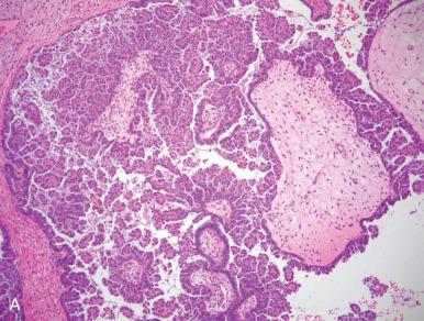 Fig. 25.17, Micropapillary growth pattern in a serous borderline tumor (SBT). A, Low-power image of numerous micropapillary clusters in an ovary. B, At higher power, long slender papillae radiate from a large central core. C, Cribriform growth pattern in an SBT. Complex ramifying cords and slim papillae are evident. D, Micropapillary growth pattern in an SBT at higher magnification. The nuclei are monomorphous. In this case, they are vesicular with small nucleoli. E, Cystic borderline tumor of the ovary with no surface or peritoneal involvement. F, There is single intracystic cribriform area in E (intraepithelial carcinoma). However, the risk of recurrence approximates that of a conventional borderline tumor.