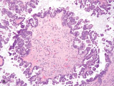 Fig. 25.18, Micropapillary features can be mimicked or found in all serous tumors, including borderline tumors (A); low-grade serous carcinomas (LGSCs; B ); and high-grade serous carcinomas (HGSCs; C ).