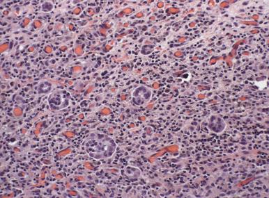 Fig. 25.19, Reactive mesothelial cells in the peritoneum. The formation of small glandlike structures and cytoplasmic vacuoles is distracting, but the nuclei are bland.