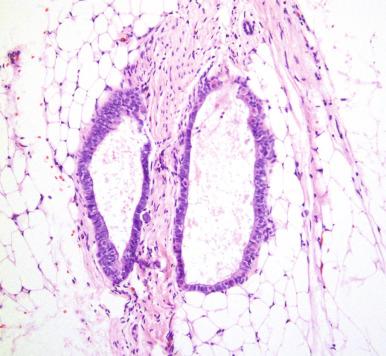 Fig. 25.20, Omentum with endosalpingiosis. There is benign müllerian inclusion without papillarity or nuclear atypia within the omental fat.