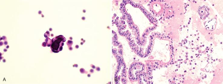 Fig. 25.21, A, Low-grade serous neoplasm in a peritoneal cytology. B, The cell block preparation suggests a borderline serous tumor, but ultimately the diagnosis must be made on tissue biopsy in such cases.