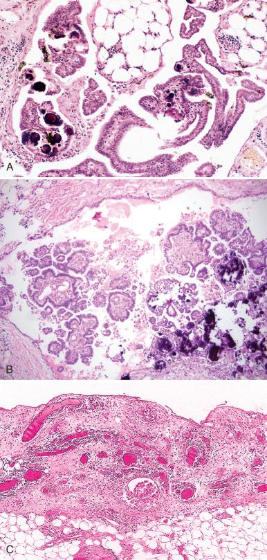 Fig. 25.22, Epithelial, noninvasive implant of a serous borderline tumor (SBT). A, Papillae with psammoma bodies, similar to those of an ovarian borderline tumor, appear to be free floating in the interstices of the omental fat. There is no stromal reaction. B, Another noninvasive implant loosely attached to the underlying adipose tissue. C, Desmoplastic noninvasive implant from an SBT. Two small islands of epithelial cells are present in a fibrovascular stroma that appears “plastered on” to the surface of the omentum.