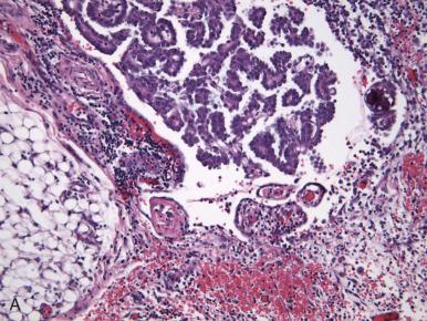 Fig. 25.24, A, Micropapillary implant. This has been added to the invasive implant group. B, Peritoneal implant with retraction artifact from a low-grade serous tumor. Some authors consider this finding in itself evidence of invasion.