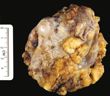 Fig. 25.25, High-grade serous carcinoma (HGSC). This fixed specimen illustrates the sharp contrast between the shiny tumor capsule and numerous surface tumor nodules, characteristic of an HGSC.