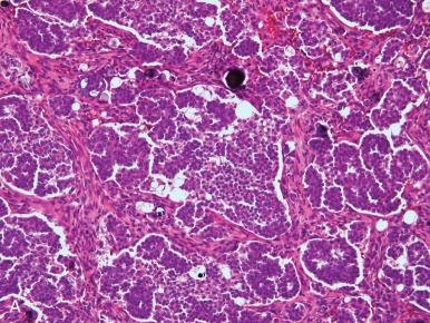 Fig. 25.30, Patterns of peritoneal invasion by low-grade serous tumors. A, Loosely arranged but dense cellular aggregates. B, Smaller papillae at high density in loose connective tissue. C, Massive involvement of the peritoneal surface by invasive well-differentiated tumor with psammoma bodies (psammocarcinoma). D, Lymph node metastasis from a low-grade serous carcinoma (LGSC).