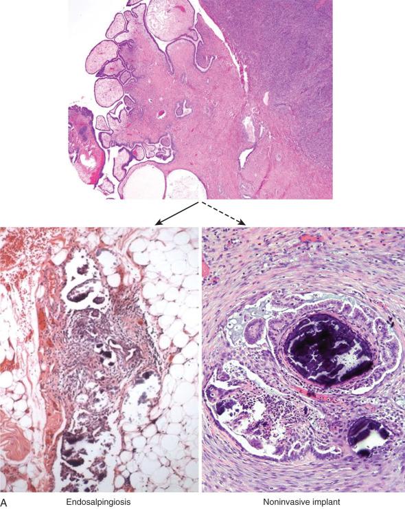 Fig. 25.3, Parallel evolution of serous tumors and their peritoneal spread. A, Benign cystadenomas are associated with endosalpingiosis and occasional noninvasive implants. In this and subsequent figures, the solid or heavier arrow depicts the most likely association. B, Borderline serous tumors can be associated with endosalpingiosis, noninvasive (mostly), and invasive (uncommonly) implants. C, Noninvasive (micropapillary) low-grade carcinomas can be associated with noninvasive, invasive (usually), and frankly malignant peritoneal implants. D, Invasive low-grade serous carcinomas (LGSCs) exhibit invasive implants or frank carcinoma in the peritoneum. E, High-grade serous carcinomas (HGSCs), as either pure tubal intraepithelial carcinoma or invasive tubal or ovarian serous carcinoma, invariably demonstrate invasive tumor in the peritoneum.