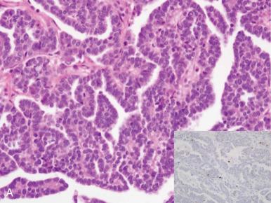 Fig. 25.31, p53 immunostaining patterns in serous carcinoma. A, A low-grade tumor displays focal staining consistent with an intact TP53 gene. B, Moderately differentiated (grade 2) serous carcinoma. There is focal micropapillary morphology. C, At higher power, the tumor exhibits uniform epithelial clusters. However, they are strongly p53 positive in keeping with a high-grade serous tumor (inset).