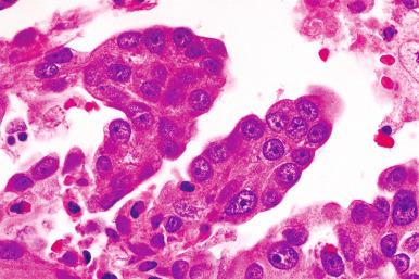 Fig. 25.32, High-grade serous carcinoma (HGSC). The nuclei are large with prominent nucleoli.