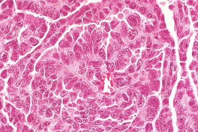 Fig. 25.33, High-grade serous carcinoma (HGSC). This illustrates a moderate degree of pleomorphism.