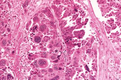 Fig. 25.34, A further example of a high-grade serous carcinoma (HGSC). In this case, there is extreme pleomorphism with bizarre, convoluted nuclear shapes.