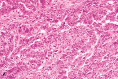 Fig. 25.35, Papillary serous carcinoma. A, Papillary architecture and high-grade nuclei are evident. B, Fine micropapillae in a high-grade serous carcinoma (HGSC).